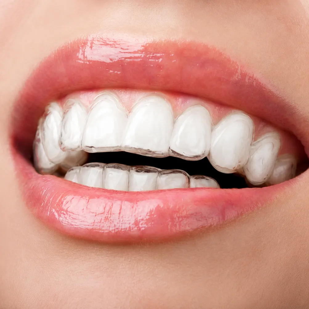 Sonrisa con alineadores invisibles goaligner transparentes